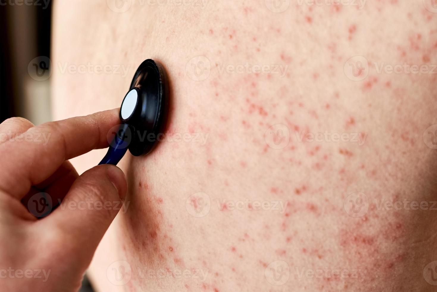 éruption cutanée allergique sur la peau. femme avec problème de dermatologie sur la peau du dos photo