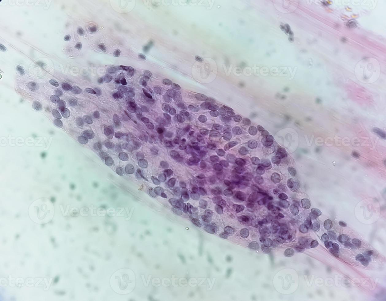 vue microscopique de trichomonas vaginalis dans un frottis vaginal avec peu de cellules inflammatoires aiguës. photo