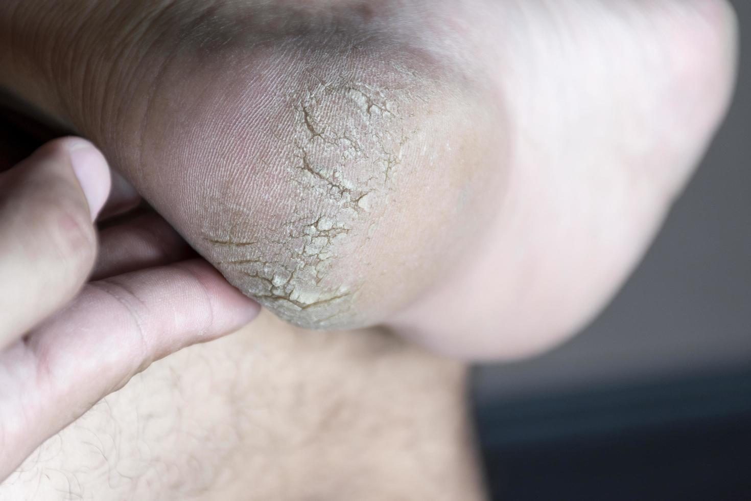 fermer le talon fissuré, fissures plus profondes et peau sèche et squameuse photo