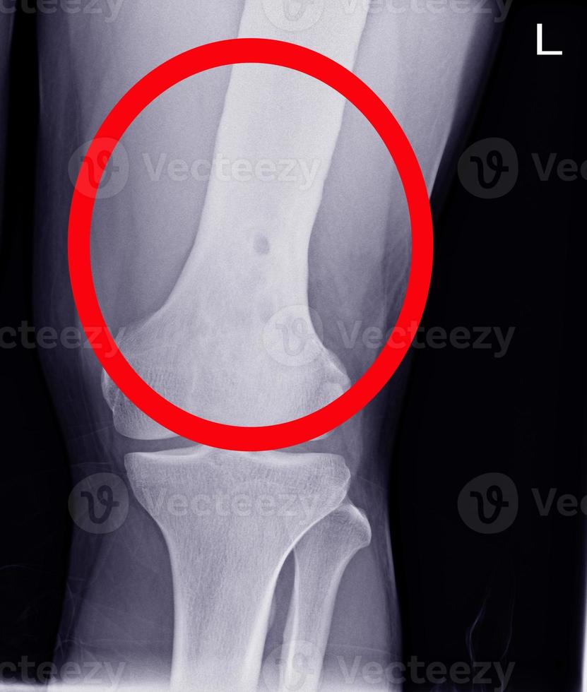 articulation du genou.pas de fracture, de luxation, de destruction osseuse. photo