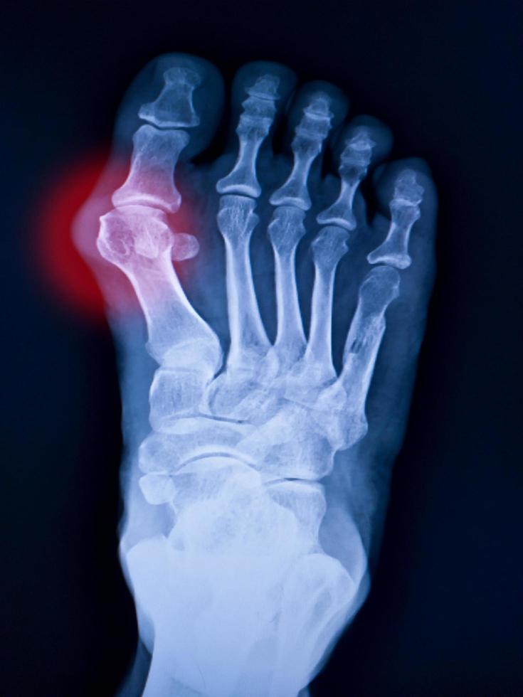 radiographie du pied et de l'arthrite à l'articulation métatarsophalangienne photo