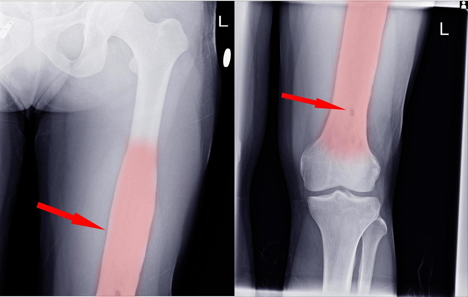 articulation du genou.pas de fracture, de luxation, de destruction osseuse. photo