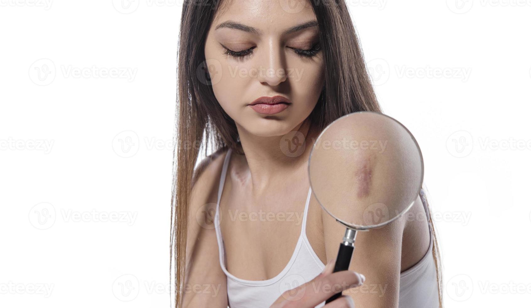 femme tenant une loupe et montrant une cicatrice d'irritation cutanée du vaccin covid 19. concept d'élimination des cicatrices, gros plan, mise au point sélective photo