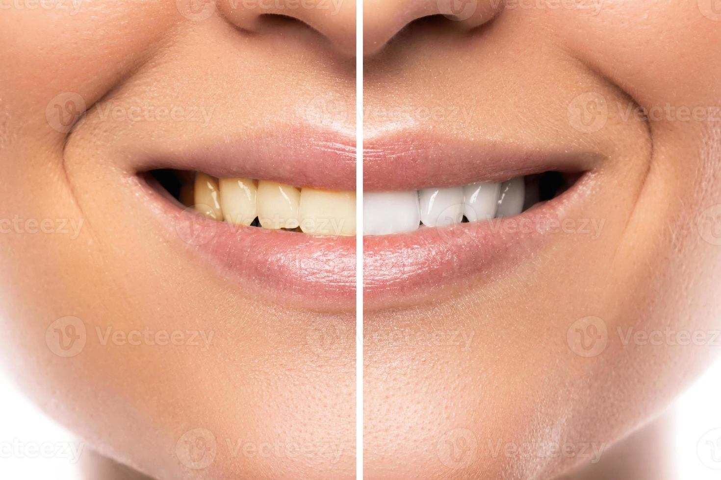 bouche féminine. comparaison avant et après blanchiment des dents photo