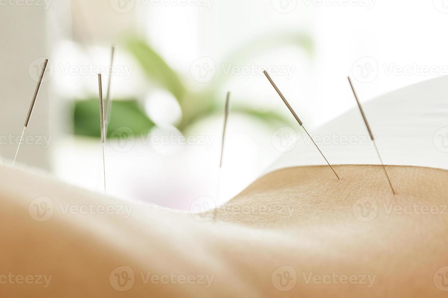 dos féminin avec des aiguilles en acier pendant la procédure de thérapie d'acupuncture photo