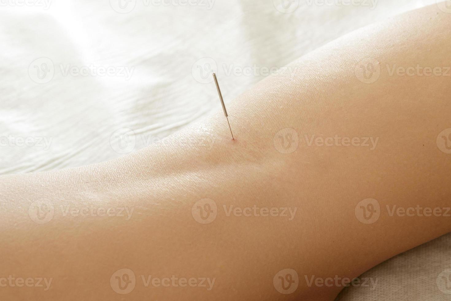 jambes féminines avec des aiguilles en acier pendant la procédure de thérapie d'acupuncture photo