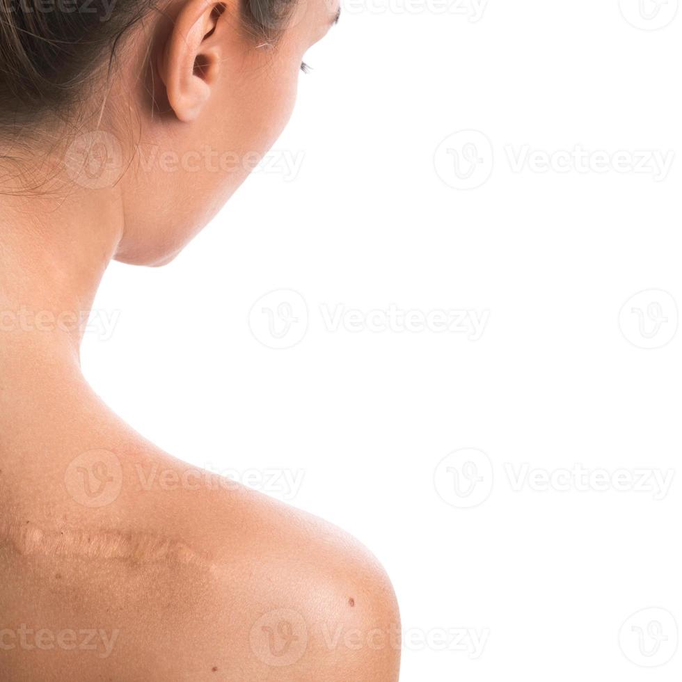 femme avec une cicatrice sur son épaule photo