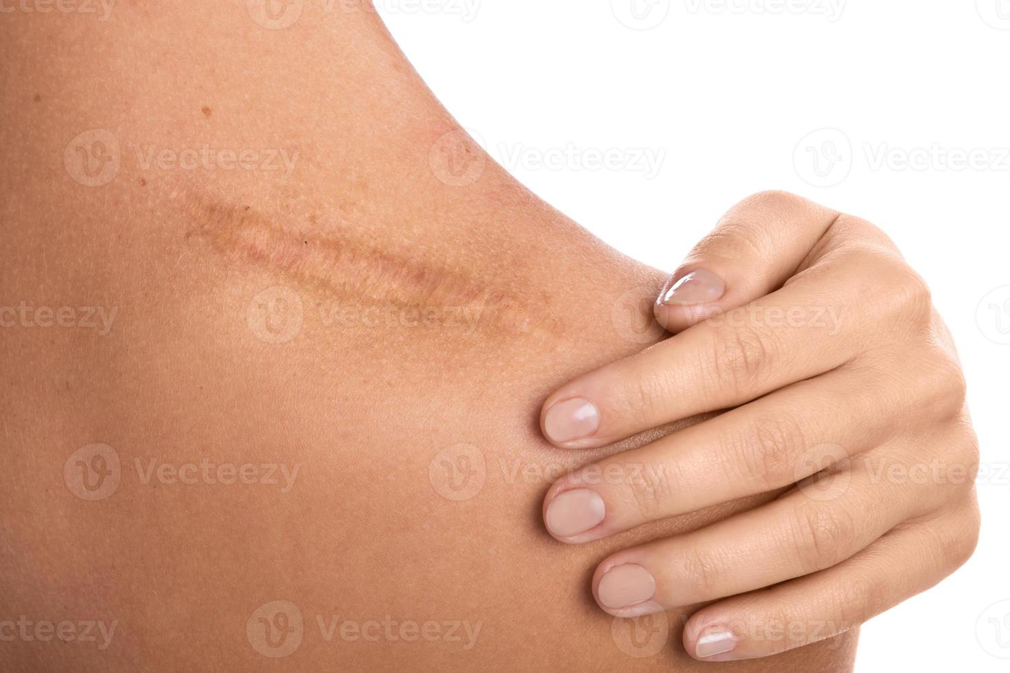 femme avec une cicatrice sur son épaule photo