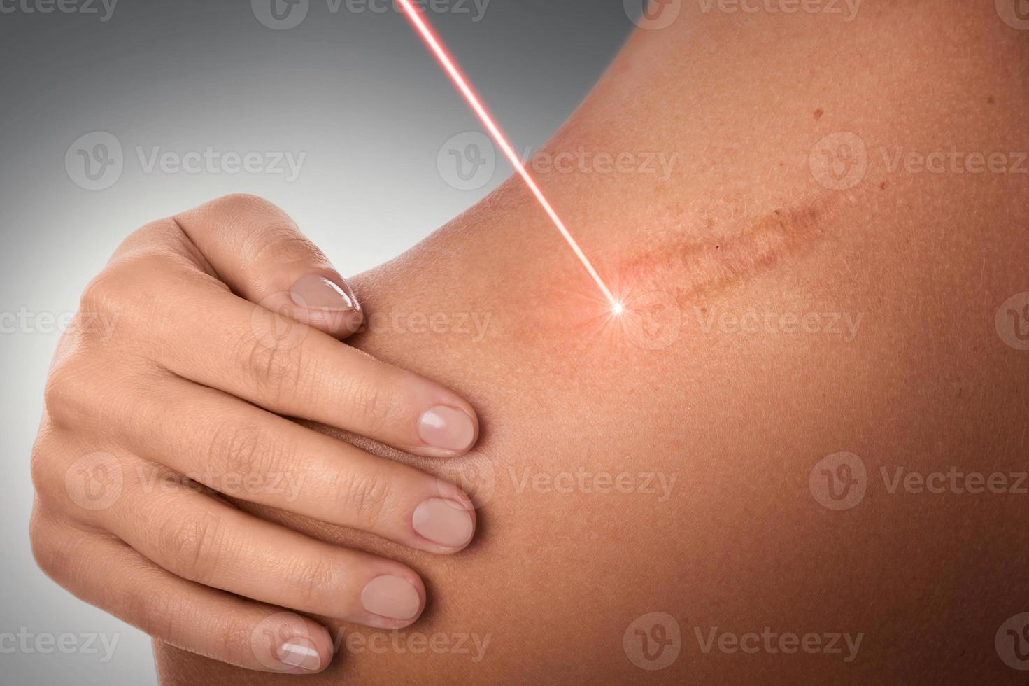 épaule féminine et faisceau laser pendant l'enlèvement de la cicatrice photo