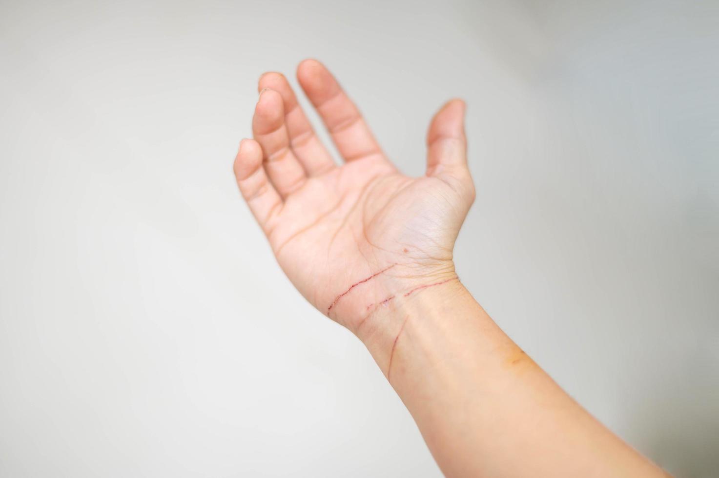 État de la peau de la main féminine après une égratignure de chat et une morsure de la main d'un vétérinaire lors d'un examen physique. photo