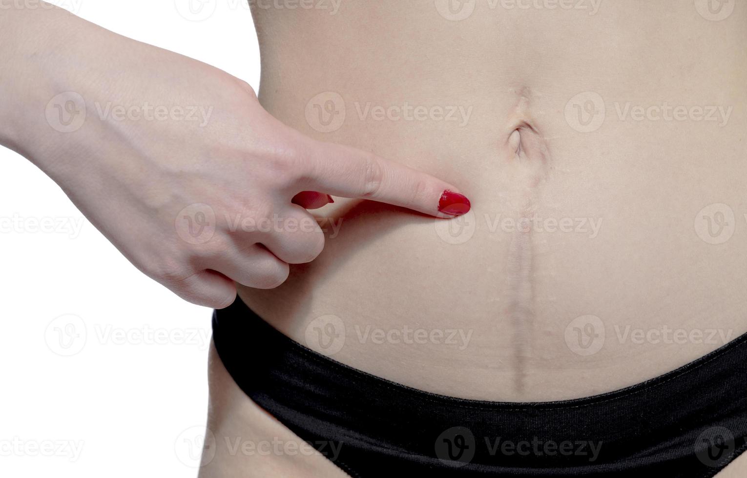 femme européenne avec de longues cicatrices abdominales après opération photo