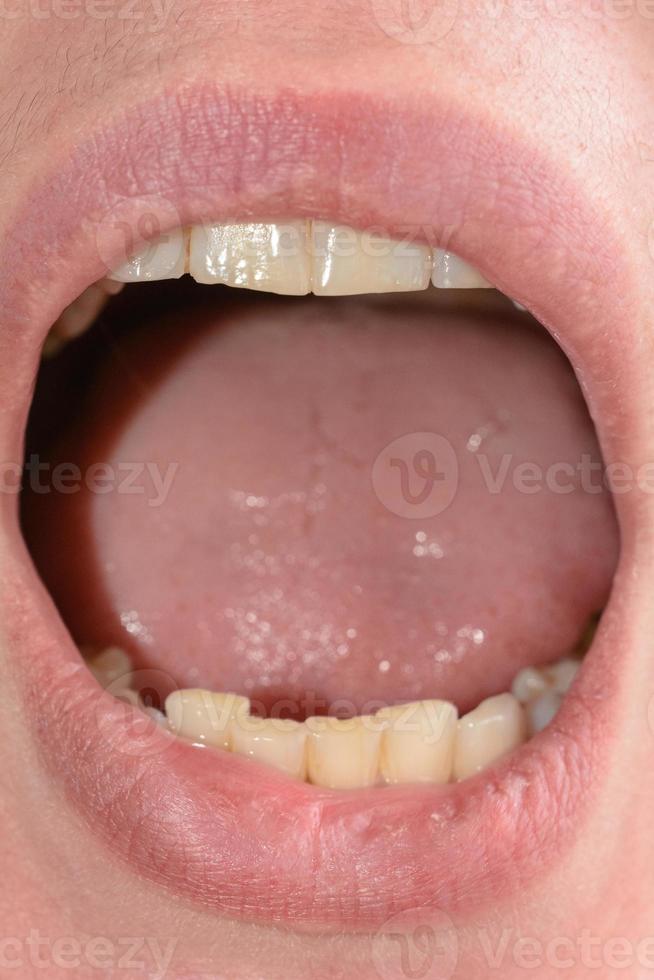 la femme ouvrit grand la bouche et montra de près ses dents tordues et pourries photo