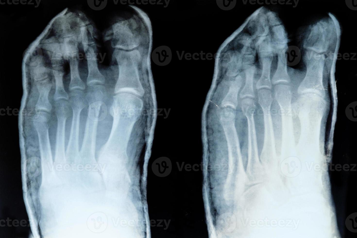 radiographie des orteils, avec petit doigt déplacé photo