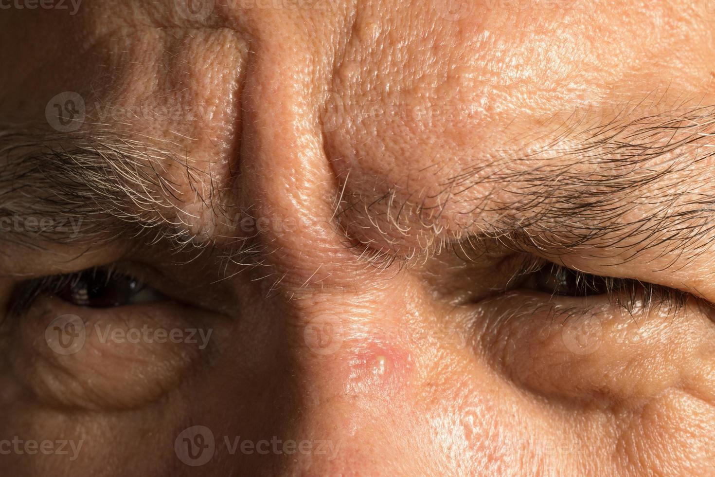 homme avec un bouton sur l'arête du nez photo