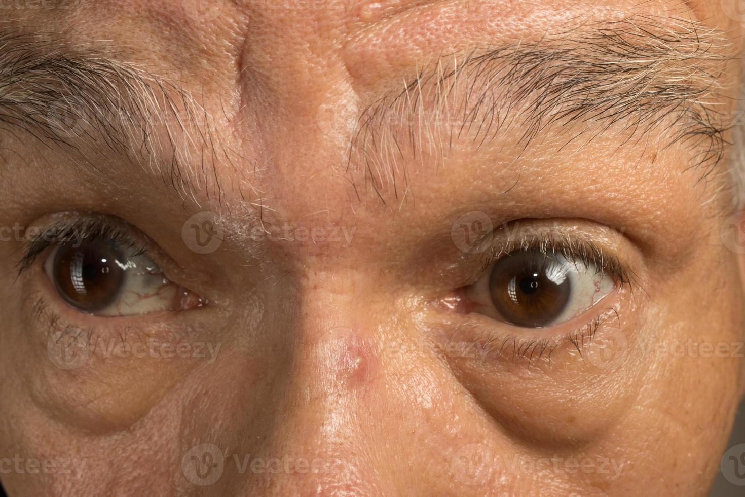 homme avec un bouton sur l'arête du nez photo