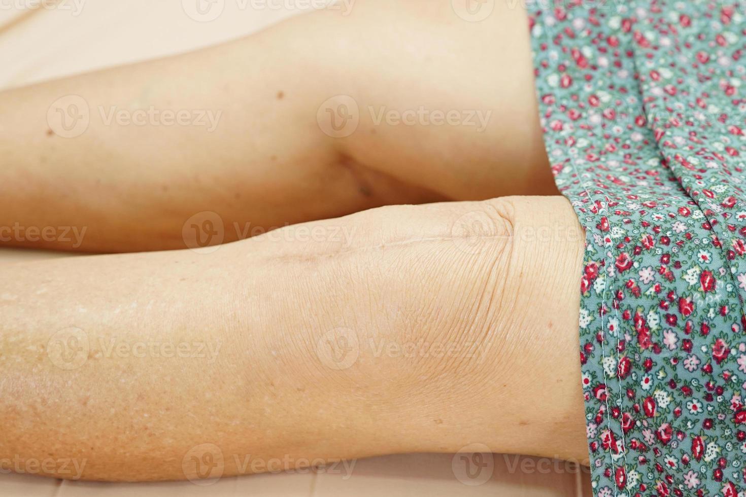 femme âgée asiatique patiente avec chirurgie de remplacement du genou cicatriciel à l'hôpital. photo