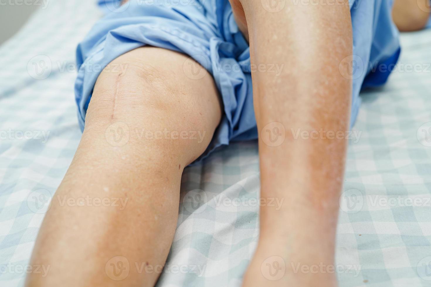 femme âgée asiatique patiente avec chirurgie de remplacement du genou cicatriciel à l'hôpital. photo