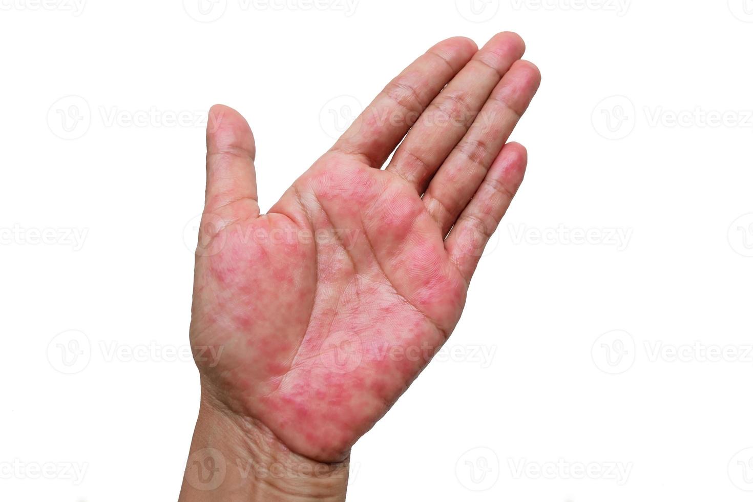 un sujet dermatite aussi connu comme un sujet eczéma, est une type de inflammation de le peau dermatite à mains sur blanc Contexte photo