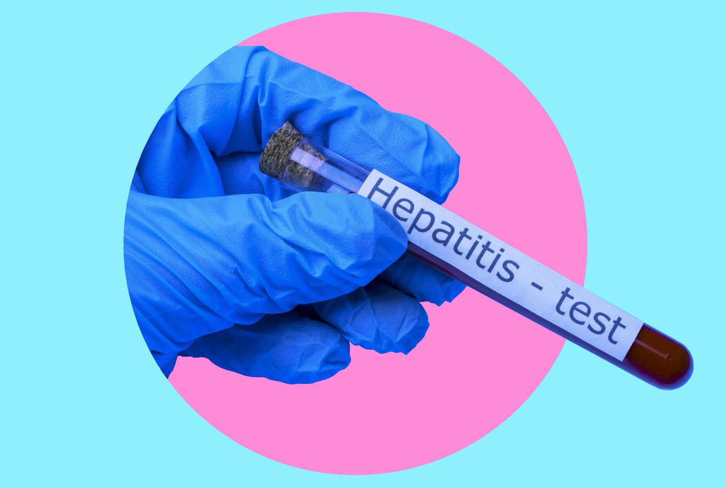 art collage, une main dans une médical gant en portant une du sang tester tube pour hépatite. photo