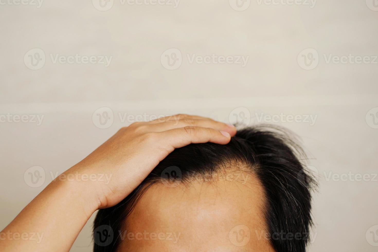 chauve Hommes et gris cheveux sont causé par stress. photo