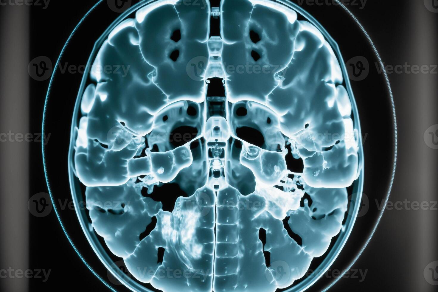 cerveau analyse radiographie après accident vasculaire cérébral génératif ai photo