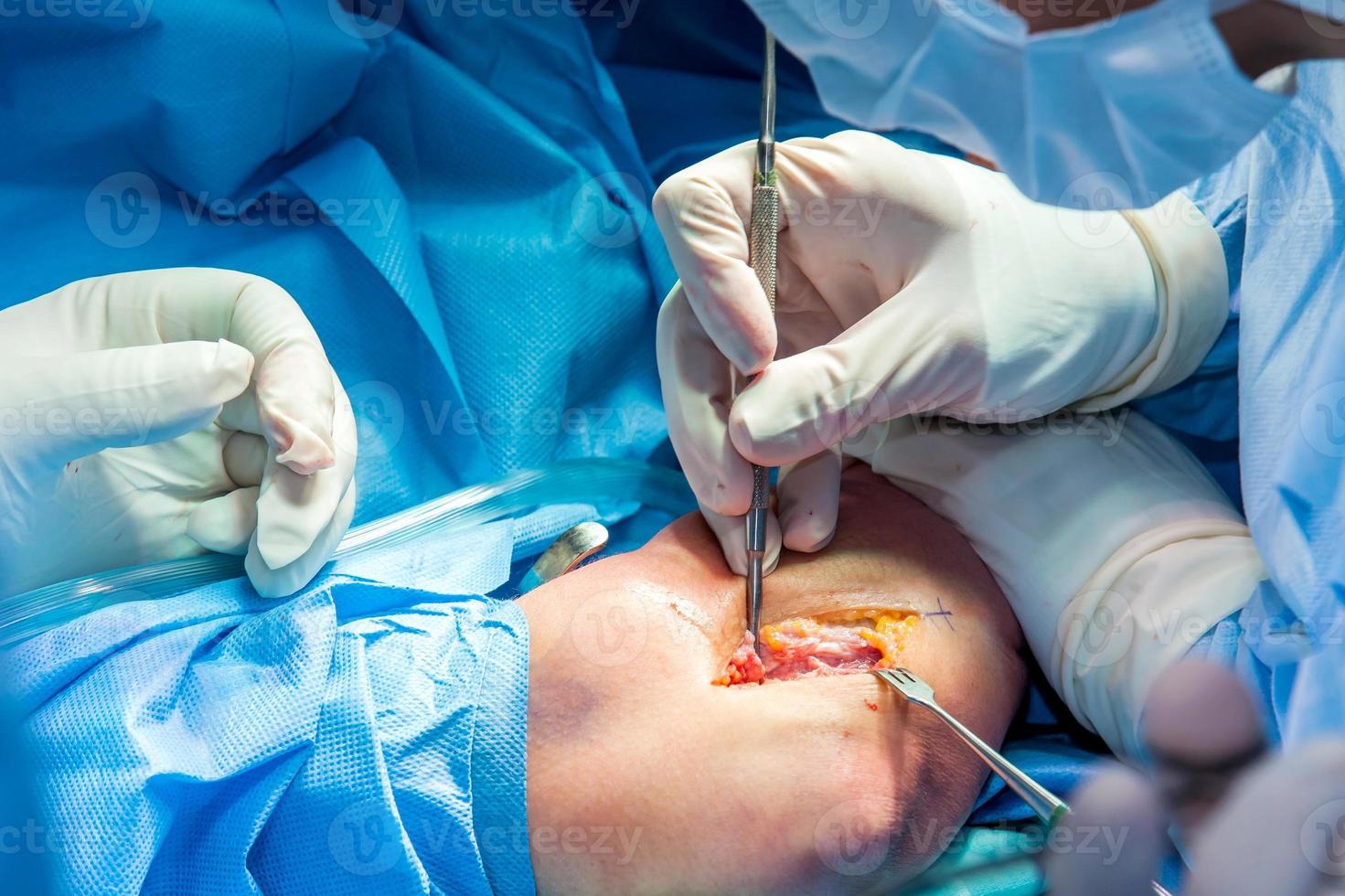 groupe de orthopédique chirurgiens performant chirurgie sur une patient bras photo