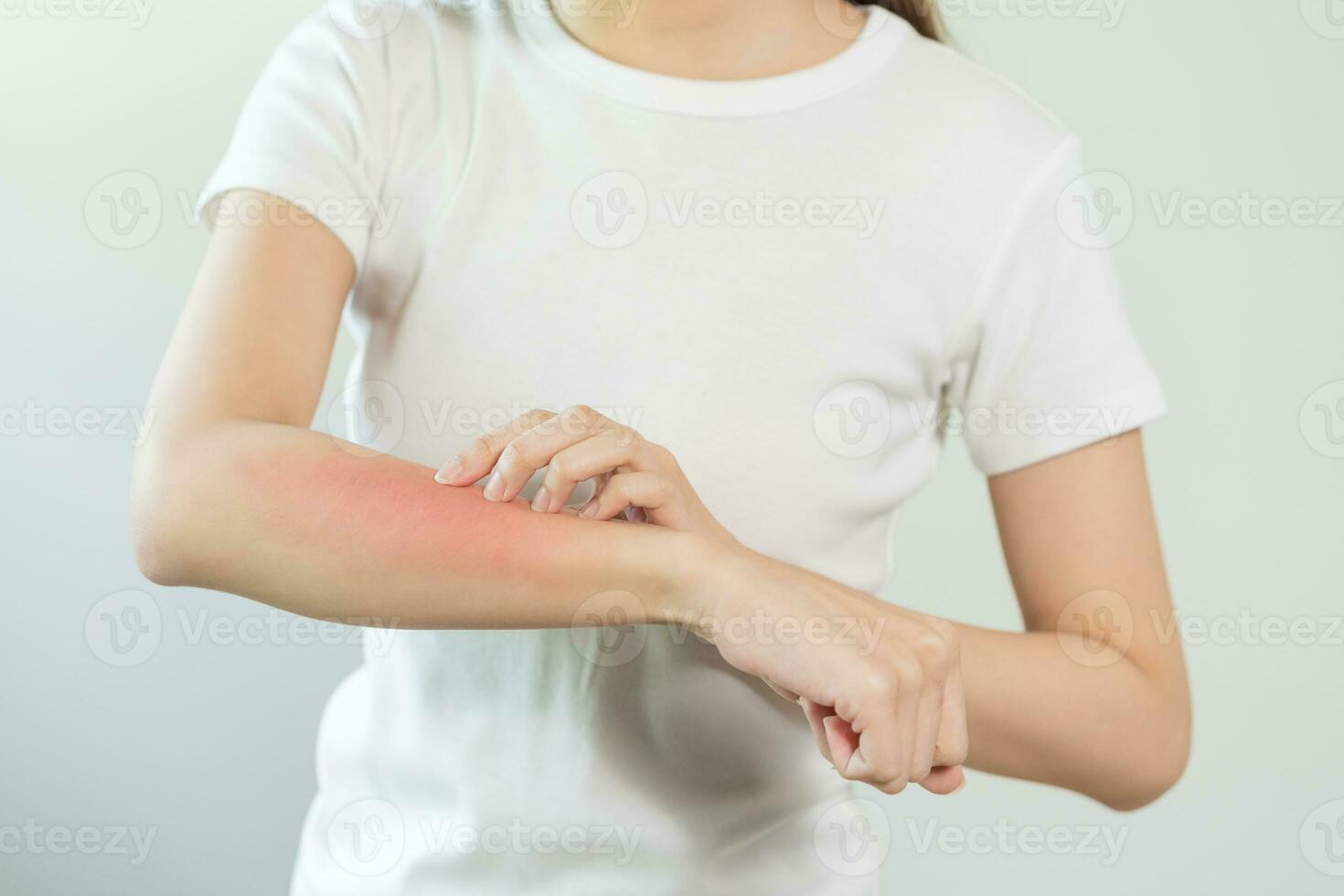 dermatologie asiatique Jeune femme, fille allergie, allergique réaction de un sujet, insecte mord sur sa bras, main dans scratch qui démange, démanger rouge place ou téméraire de peau. soins de santé, traitement de beauté. photo