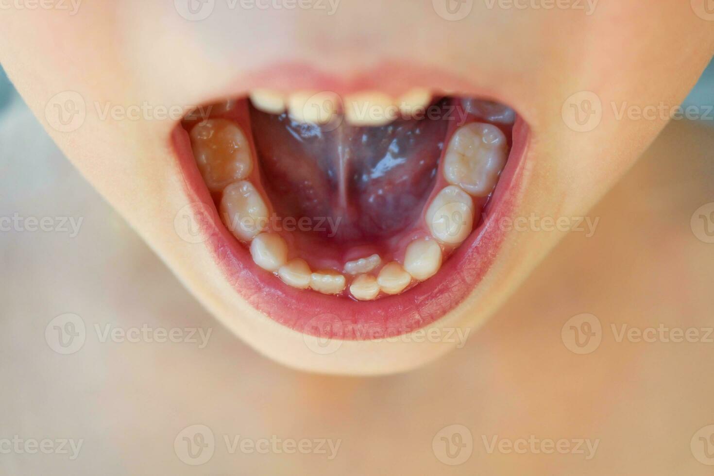 bébé dent est encore ne pas abandonné, le suivant grandi racine dent photo
