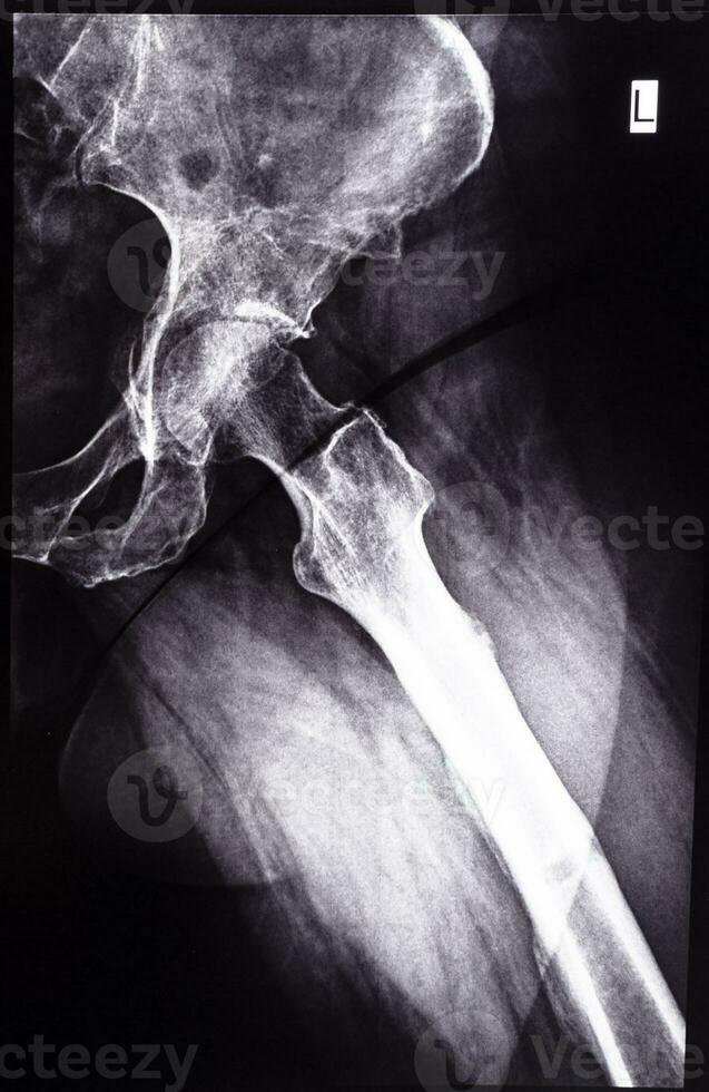 négatif radiographie côté vue de acétabulaire cavité photo