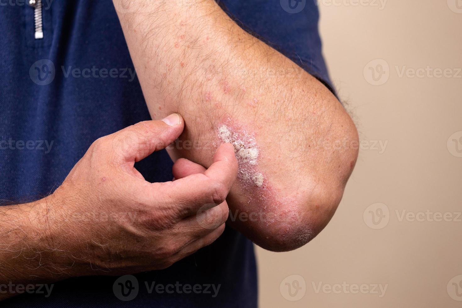 dermatite en gros plan sur la peau photo