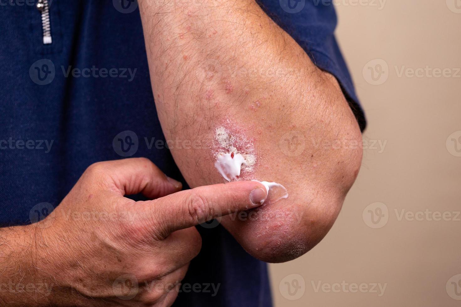 photo conceptuelle du traitement des maladies de la peau à l'aide de pommades comme dosage