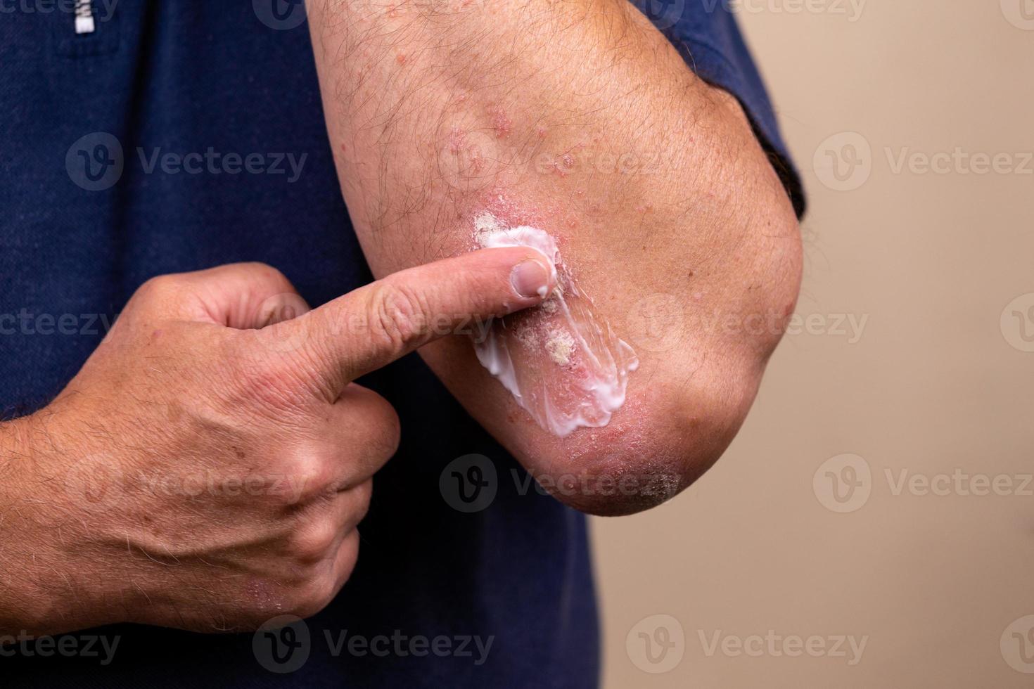 photo conceptuelle du traitement des maladies de la peau à l'aide de pommades comme dosage