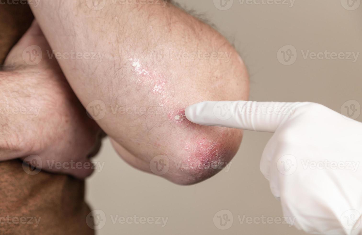 le médecin examine le psoriasis photo