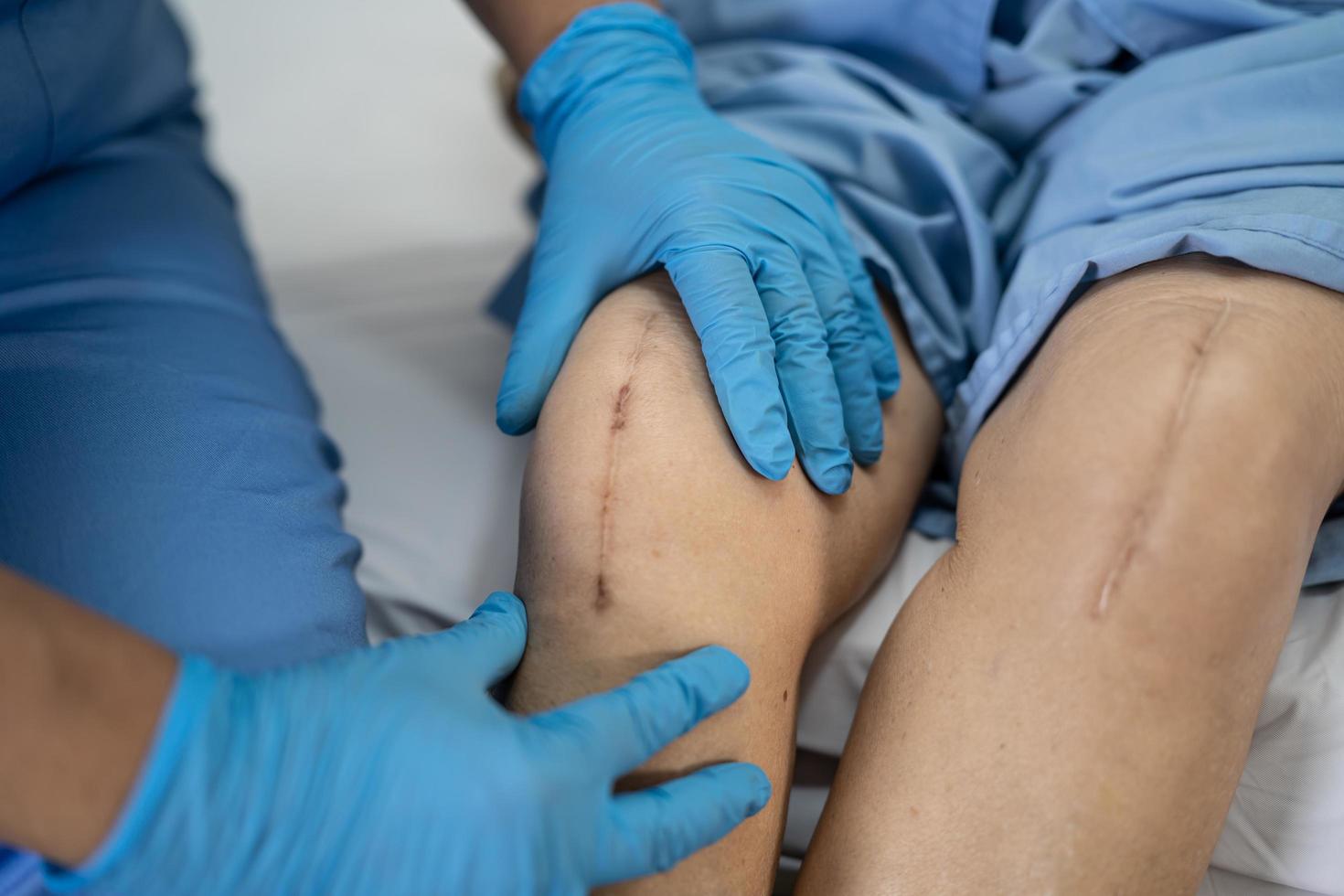 Asiatique senior ou âgée vieille dame femme patiente montrer ses cicatrices chirurgicale remplacement de l'articulation du genou total suture chirurgie des plaies arthroplastie sur lit en salle d'hôpital de soins infirmiers photo