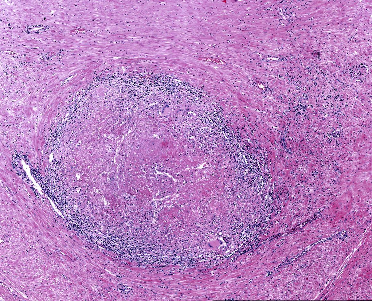 cellule de langhans de granulome tuberculeux photo