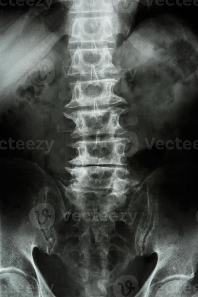 Film de spondylose xray ls colonne vertébrale sacrum lombaire de vieux patient âgé photo