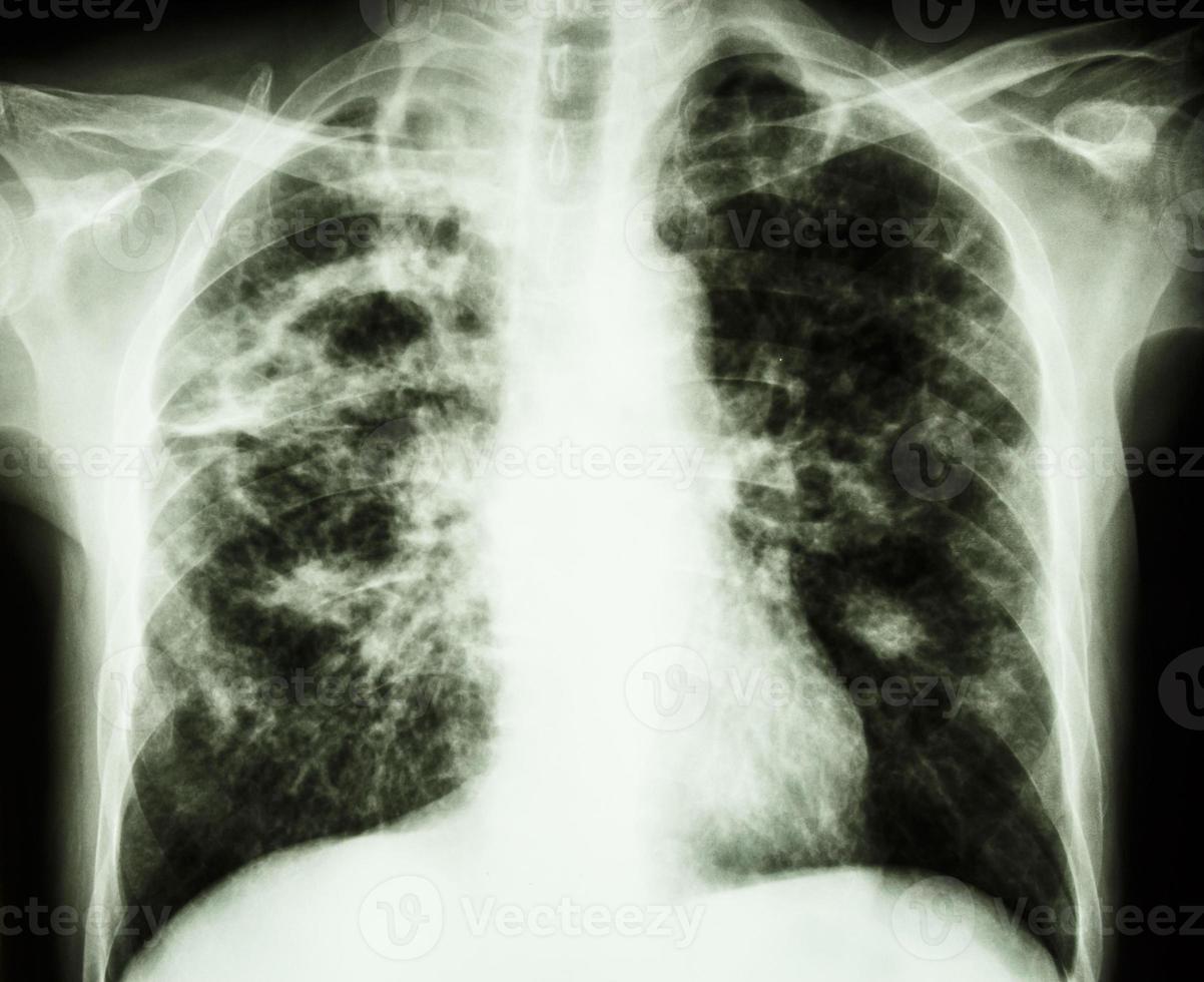 radiographie pulmonaire sur film montre une cavité au niveau du poumon droit fibrose infiltrat interstitiel irrégulier au niveau des deux poumons en raison d'une infection à mycobacterium tuberculosis tuberculose pulmonaire photo