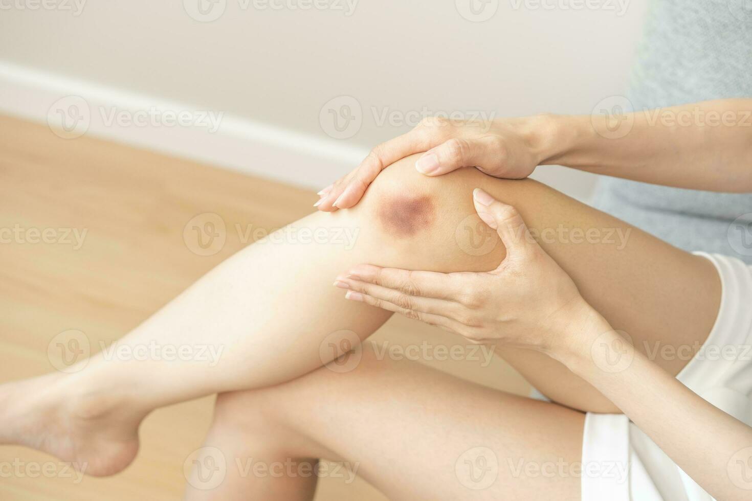 proche en haut de tache bleu blessure sur jambe, contusion asiatique Jeune femme, fille sur mixte le genou de un accident est tombée bas, main dans guérison blessure par massage hématome sang. extravasation bleu, violet sur peau. photo