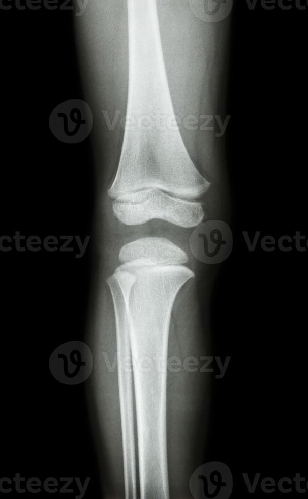 film x ray genou ap antero vue postérieure de l'enfant photo