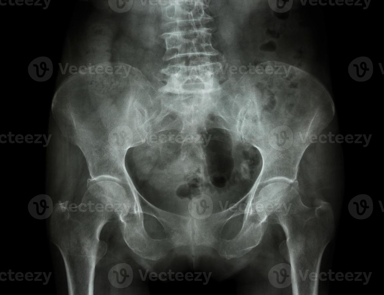 film x ray bassin de patient ostéoporotique photo