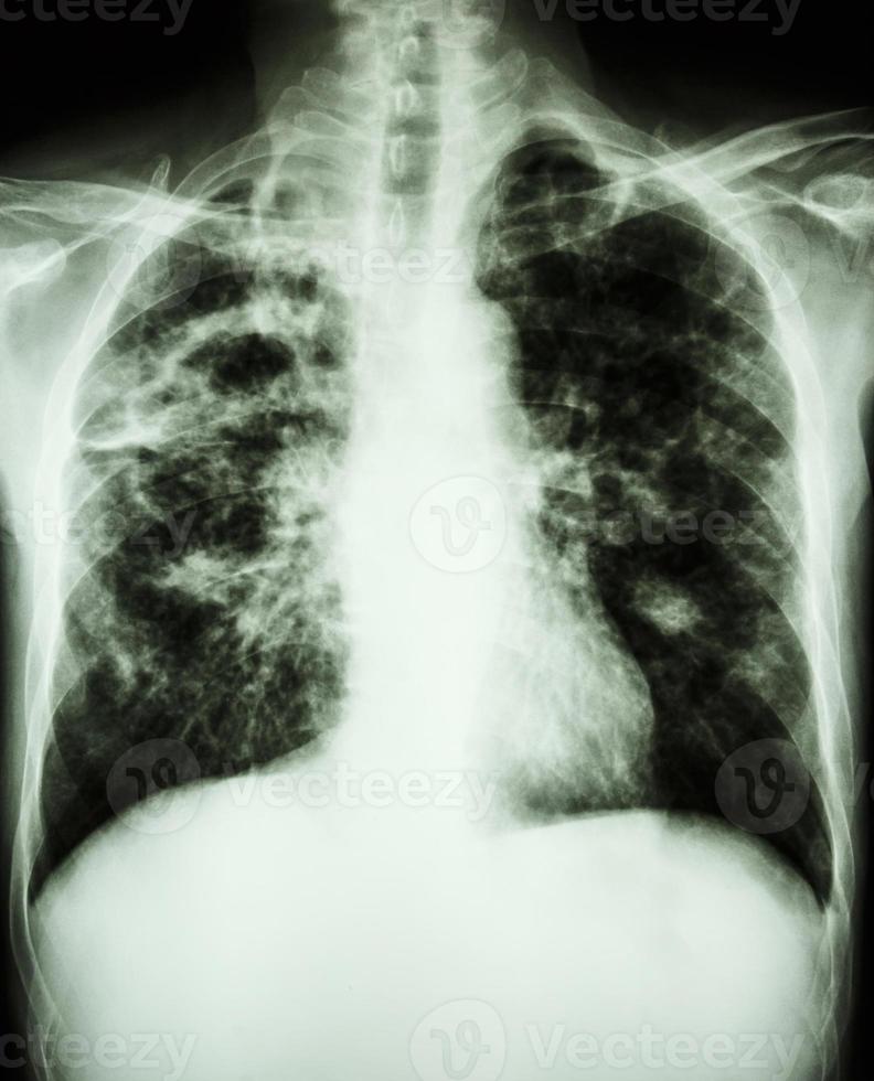 film radiographie pulmonaire montrant la cavité au poumon droit, la fibrose et l'infiltrat interstitiel et inégal aux deux poumons en raison d'une infection à Mycobacterium tuberculosis tuberculose pulmonaire photo