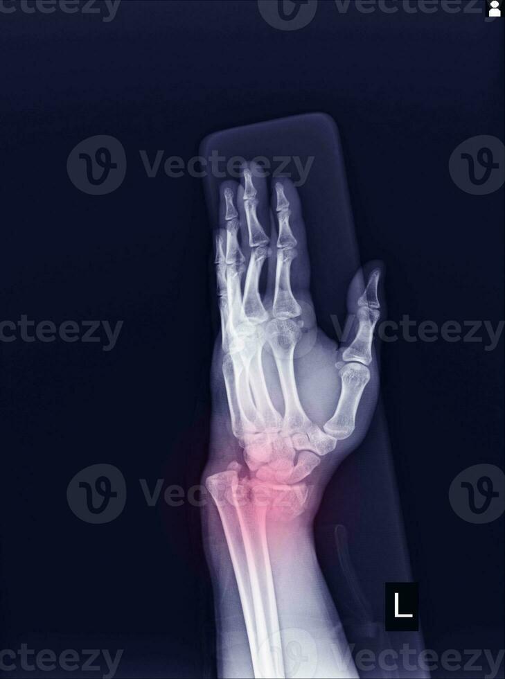 radiographie la gauche poignet mixte fracture avec déplacement distal fin la gauche rayon. photo