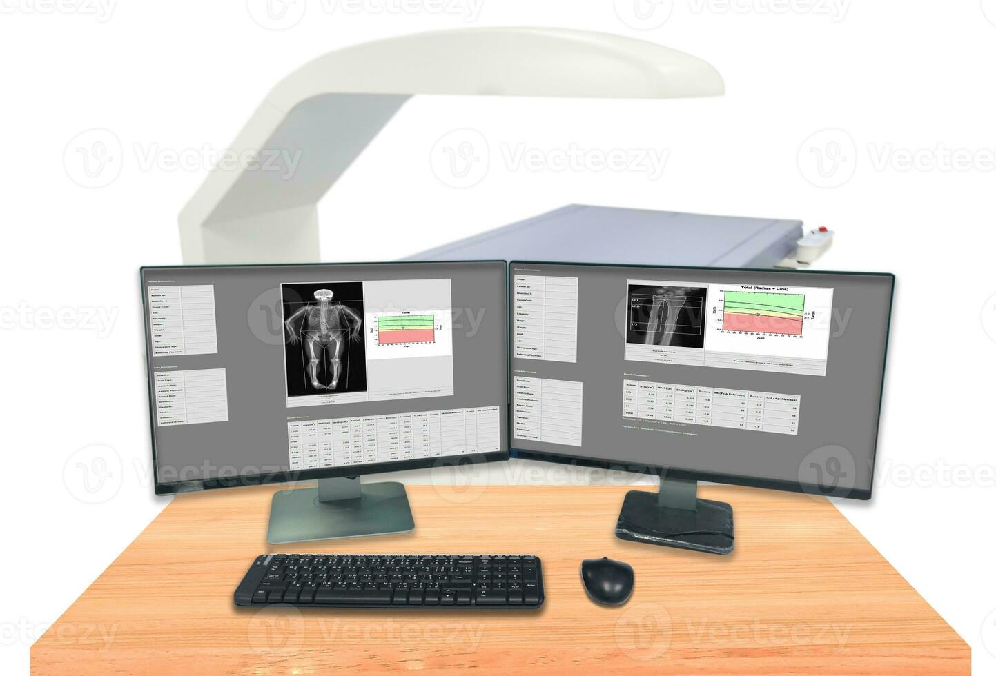 proche en haut OS densité entier corps et poignet ,le radiographie département de hôpital utilisé pour diagnostiquer l'ostéoporose symptômes.surface floue image et image contient excessif bruit, film grain, photo