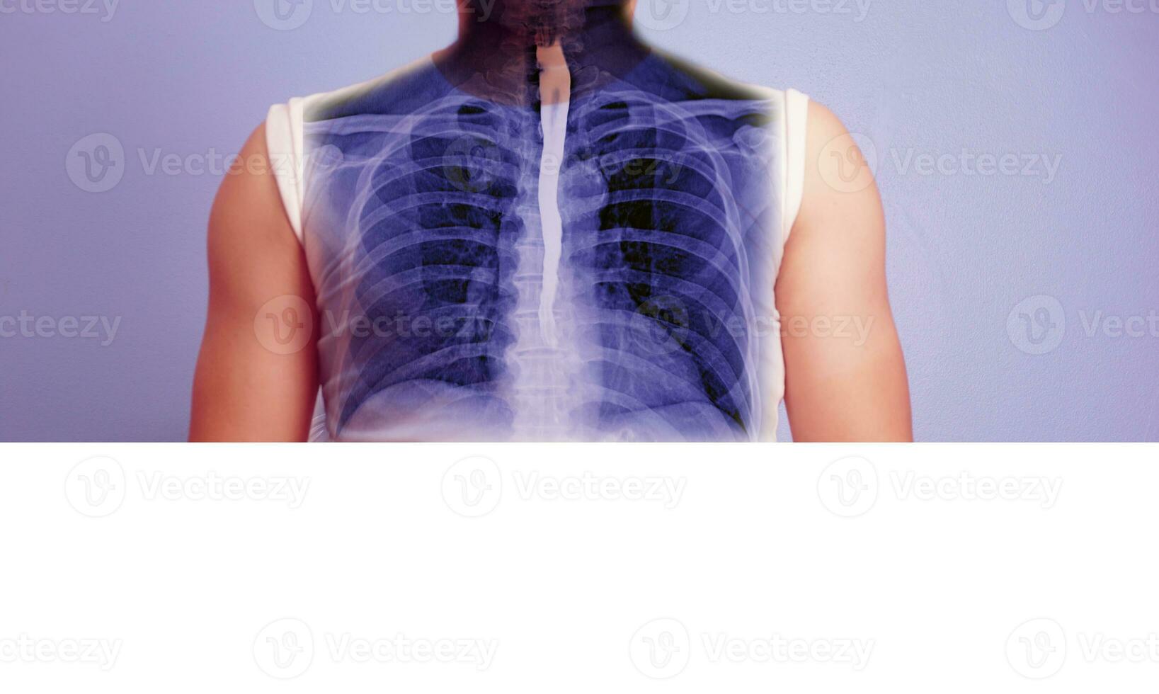 oesophagramme et baryum avaler ap vue comparer après le patient les boissons une liquide cette contient baryum montrant œsophage. photo