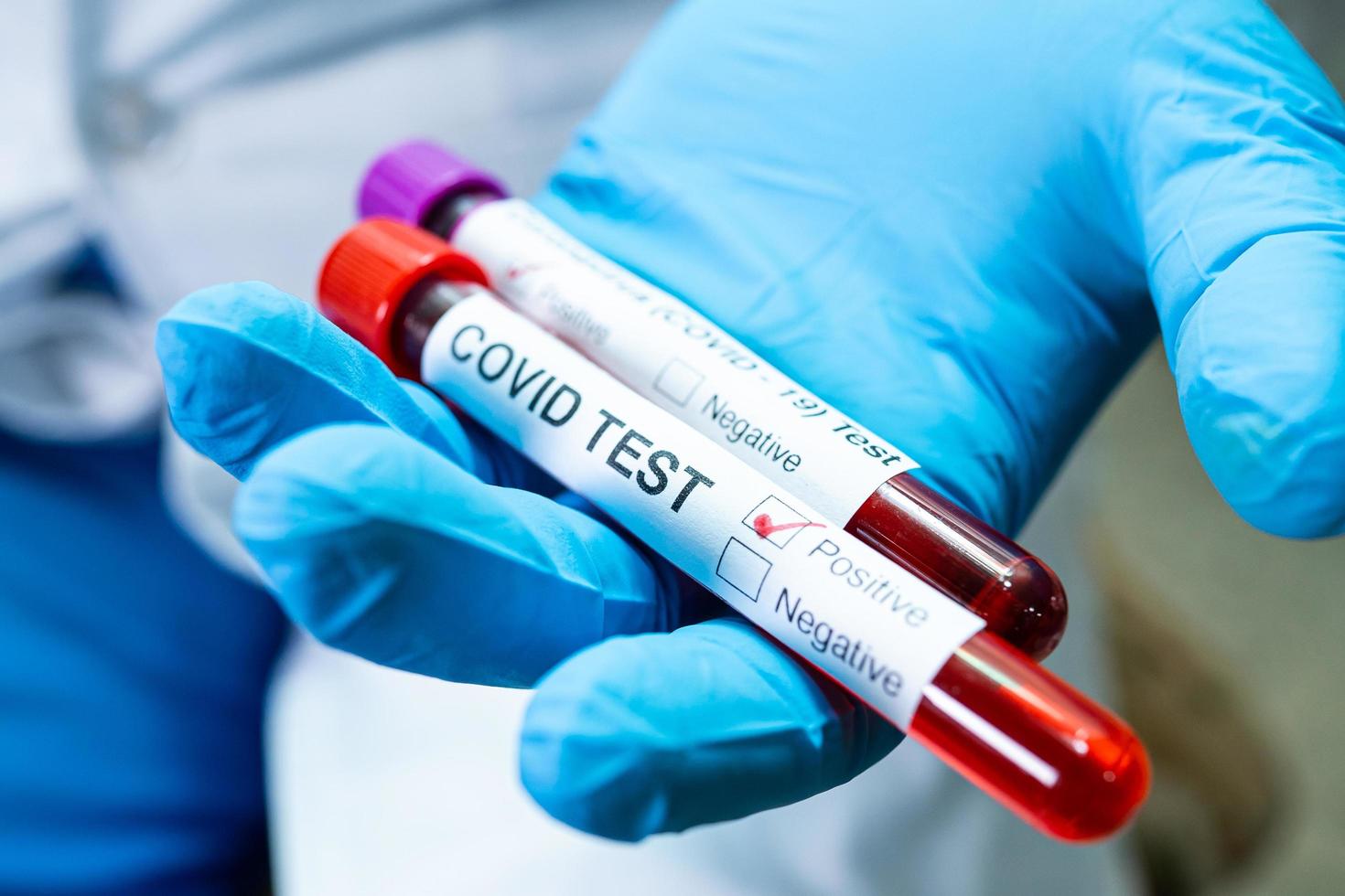 échantillon d'infection sanguine positif dans un tube à essai pour le coronavirus covid-19 en laboratoire. scientifique tenant pour vérifier et analyser le patient à l'hôpital. photo