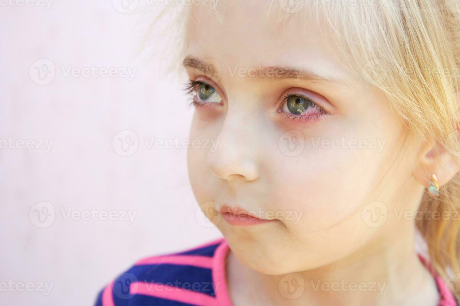 fermer de une fille avec conjonctivite . photo