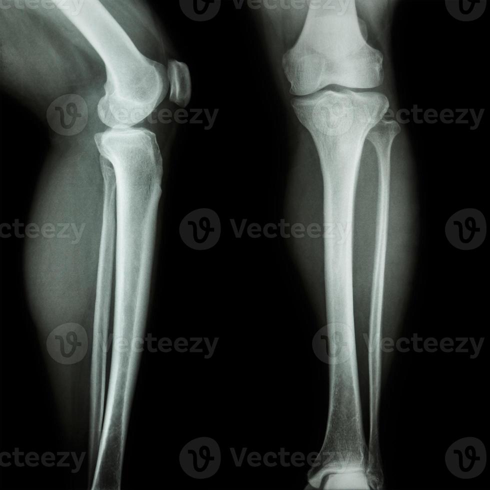 film radiographie jambe et genou vue ap antéro-postérieure - latérale photo