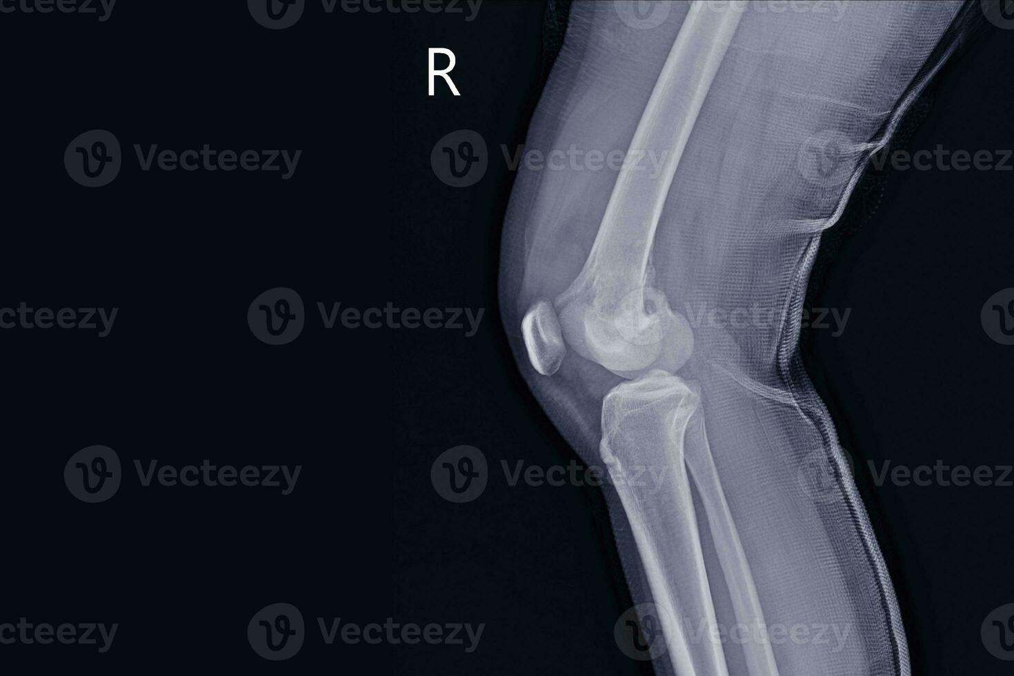 radiographie le genou joindre une femelle 15 année vieux montrant grand ostéolytique lésion de médian aspect de droite distal fémur.avec doux tissu masse.et malin OS tumeur, ostéosarcome est soupçonné. photo