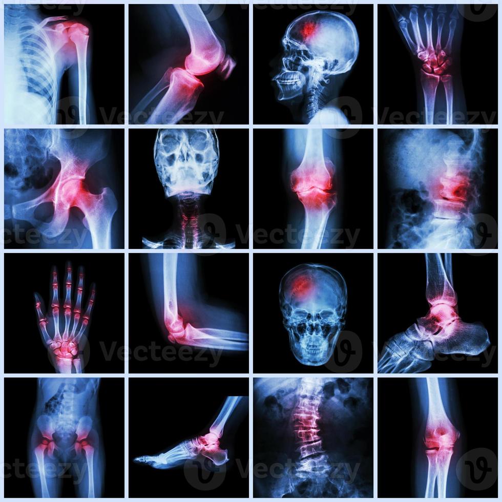 collection d'articulations humaines et d'arthrite et d'accident vasculaire cérébral photo