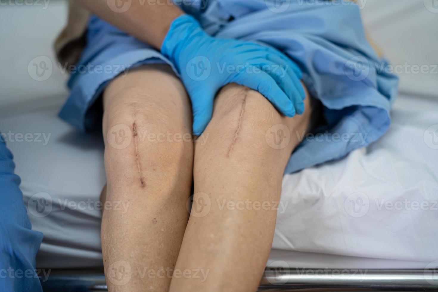 Une patiente asiatique âgée ou âgée montre ses cicatrices Chirurgie de remplacement total de l'articulation du genou Chirurgie des plaies arthroplastie sur lit dans la salle d'hôpital de soins infirmiers, concept médical solide et sain. photo